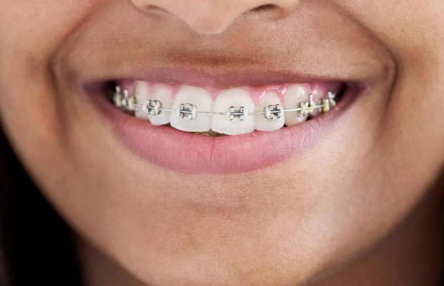 Close up of the smile of a young adult with metal braces