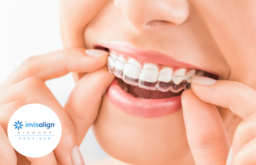 Woman with putting in invisalign aligner and top 1% Diamond Invisalign Provider button