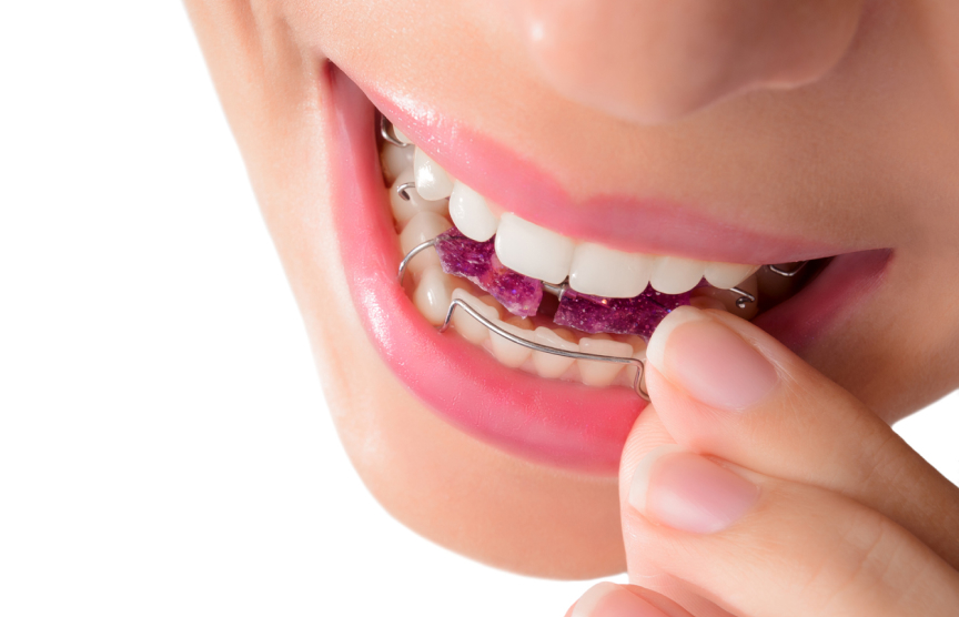 Close up of the smile of a woman with a pink removable retainer