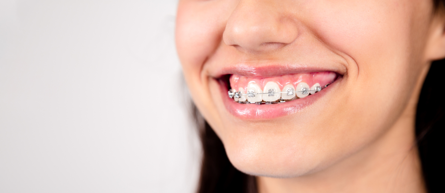 Mouth of a teen girl smiling showing metal orthodontics. White background.